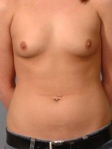 Breast Augmentation - Case 12752 - Before