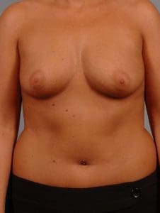 Breast Augmentation - Case 12783 - Before