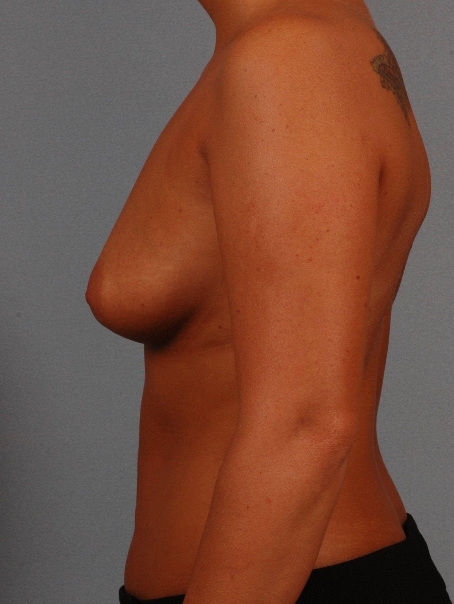 Breast Augmentation Patient Photo - Case 12783 - before view-1