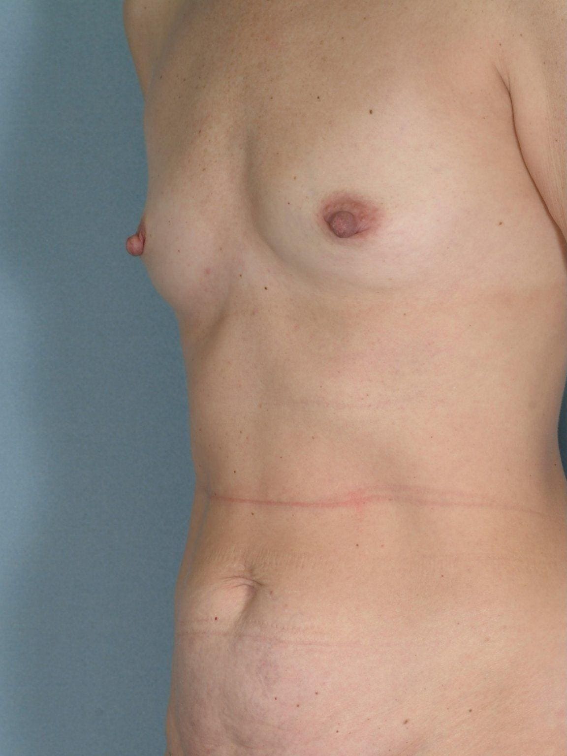 Breast Augmentation Patient Photo - Case 12795 - before view-1