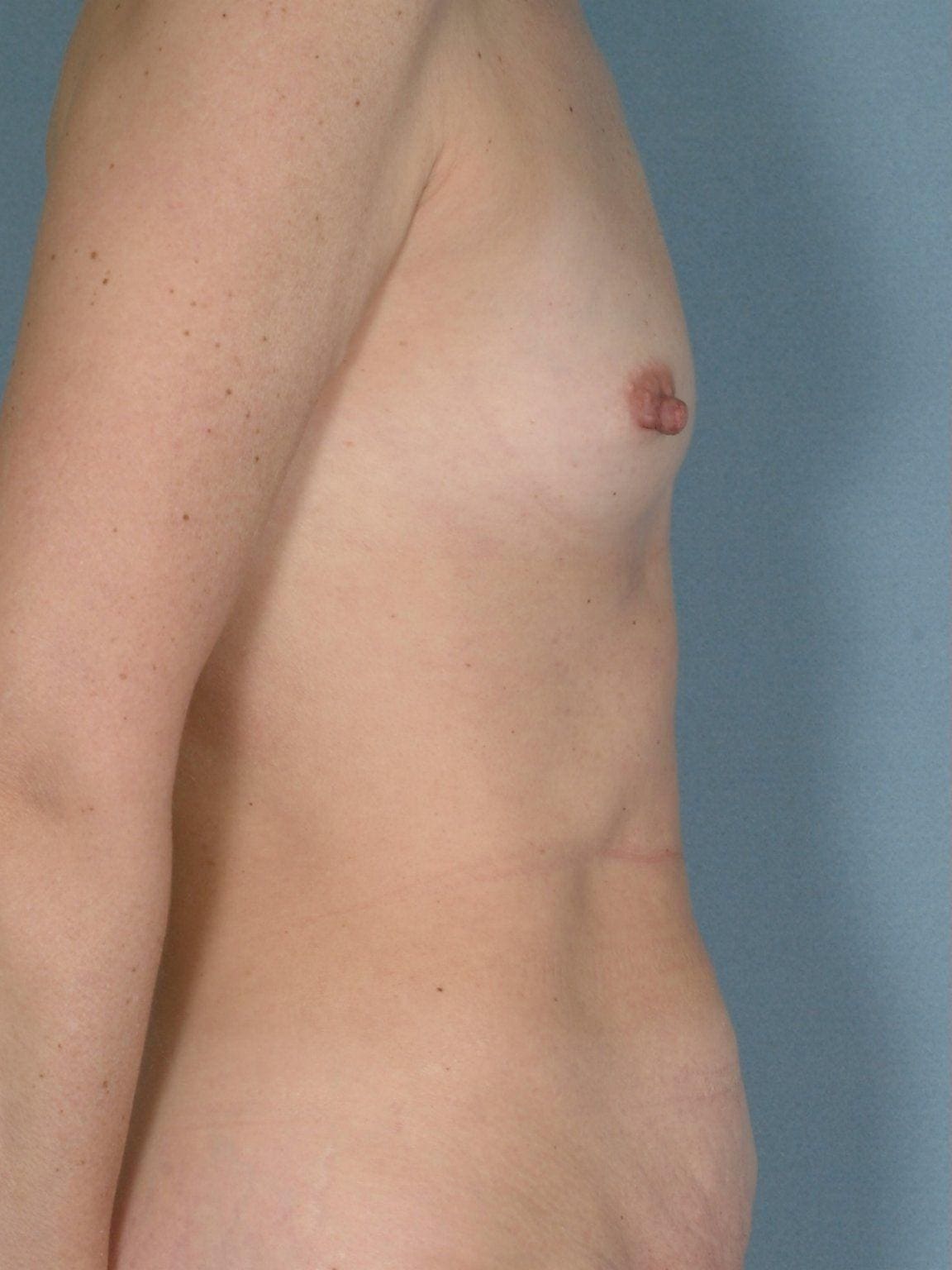 Breast Augmentation Patient Photo - Case 12795 - before view-2