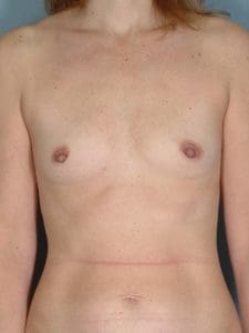 Breast Augmentation - Case 12795 - Before