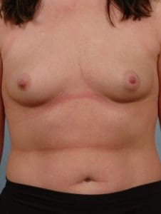 Breast Augmentation - Case 12805 - Before