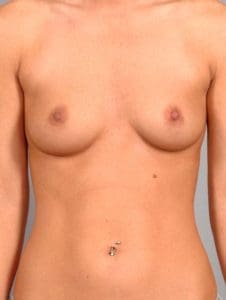 Breast Augmentation - Case 12817 - Before