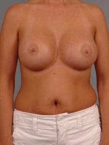 Breast Augmentation - Case 12851 - After