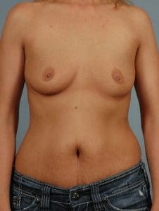 Breast Augmentation - Case 12851 - Before