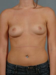 Breast Augmentation - Case 12887 - Before