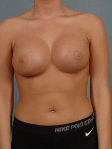 Breast Augmentation - Case 12887 - After