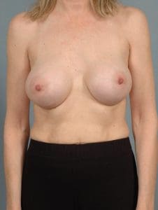 Breast Augmentation - Case 12899 - After