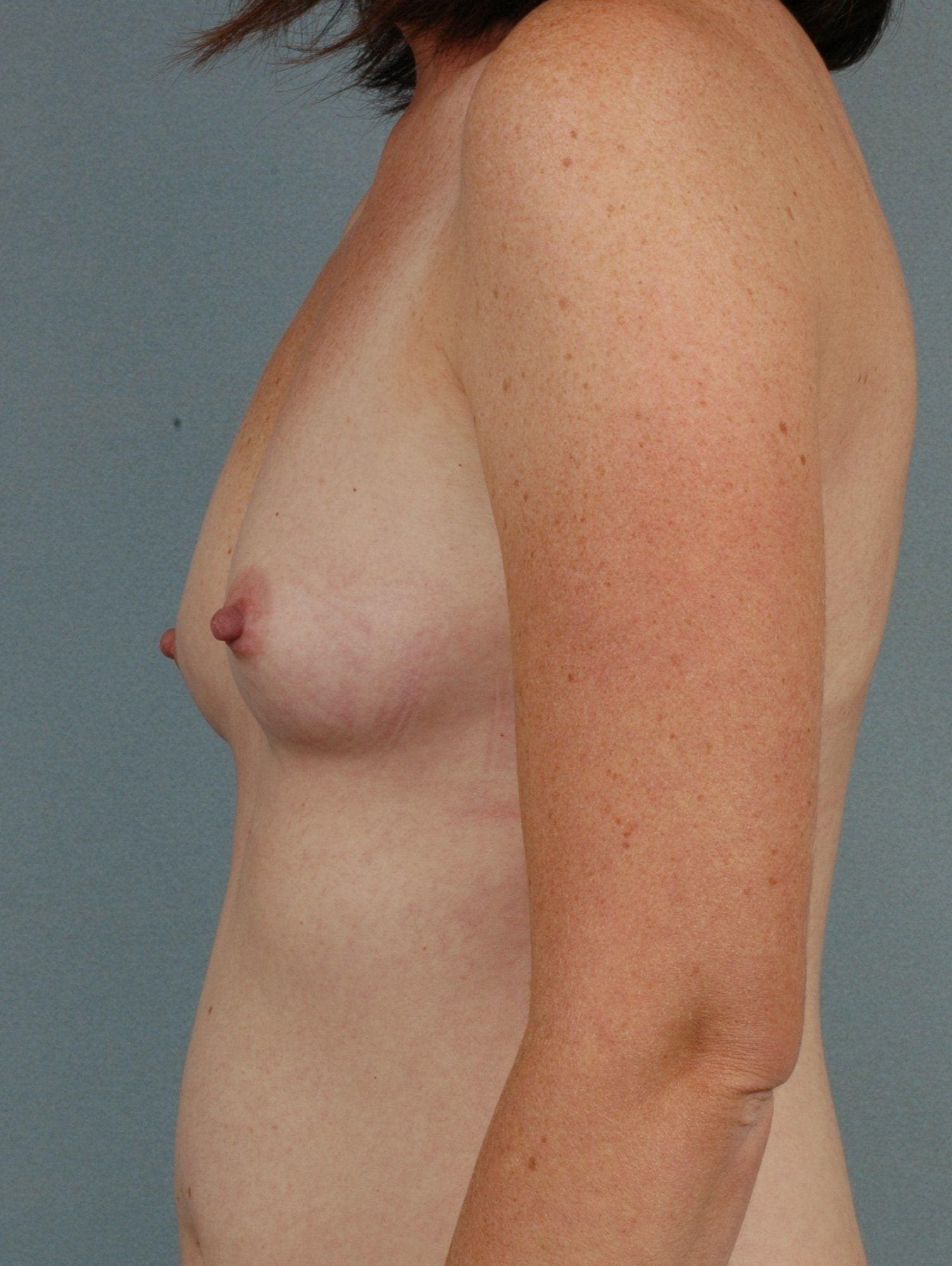 Breast Augmentation Patient Photo - Case 12905 - before view-1