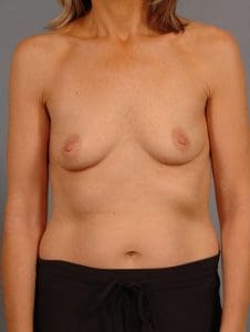 Breast Augmentation - Case 12977 - Before