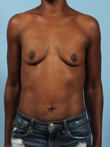 Breast Augmentation - Case 13002 - Before