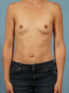 Breast Augmentation - Case 13049 - Before