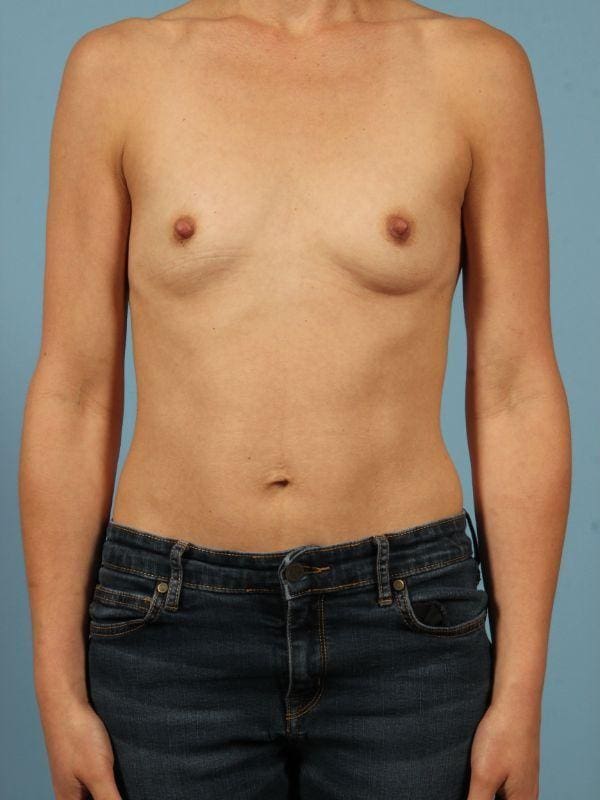 Breast Augmentation Patient Photo - Case 13049 - before view-
