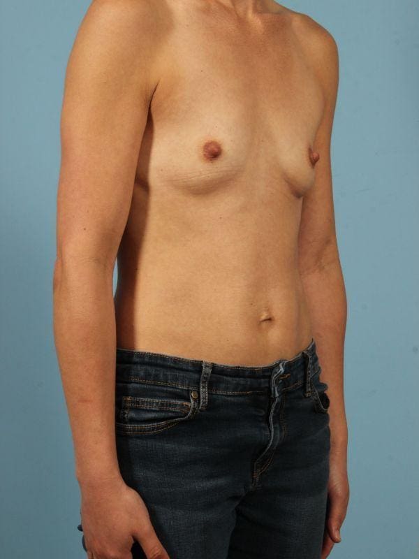 Breast Augmentation Patient Photo - Case 13049 - before view-4