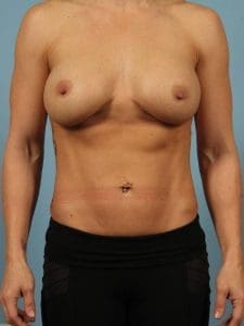 Breast Augmentation - Case 13062 - After