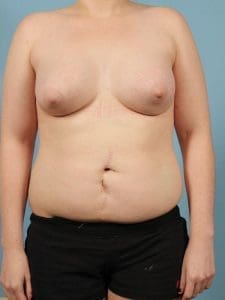 Breast Augmentation - Case 13075 - After