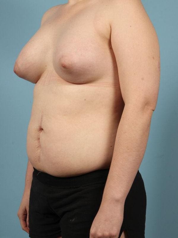 Breast Augmentation Patient Photo - Case 13075 - after view-3