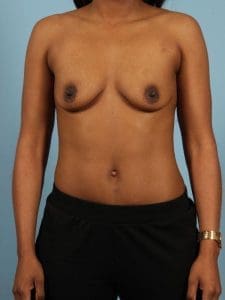 Breast Augmentation - Case 13098 - Before