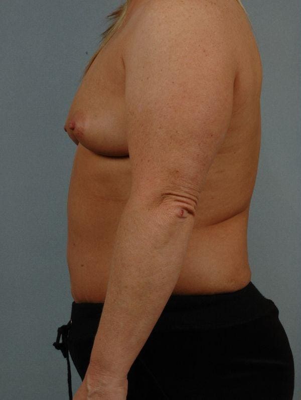Breast Augmentation Patient Photo - Case 13112 - before view-1