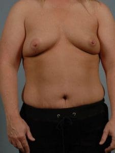 Breast Augmentation - Case 13112 - Before