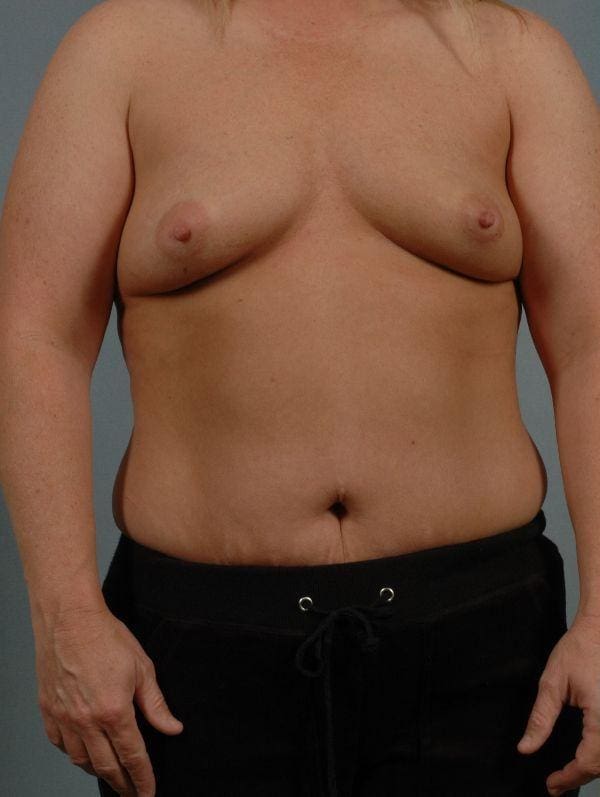 Breast Augmentation Patient Photo - Case 13112 - before view-