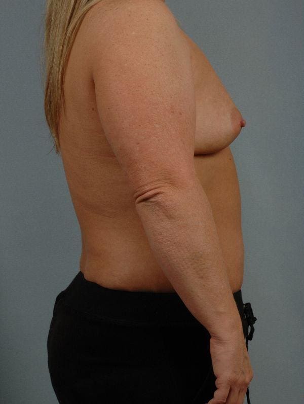 Breast Augmentation Patient Photo - Case 13112 - before view-2