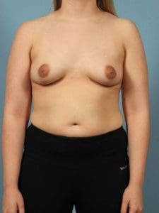 Breast Augmentation - Case 13136 - Before