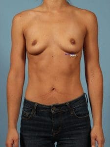 Breast Augmentation - Case 13160 - Before