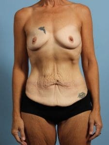 Breast Augmentation - Case 13172 - Before