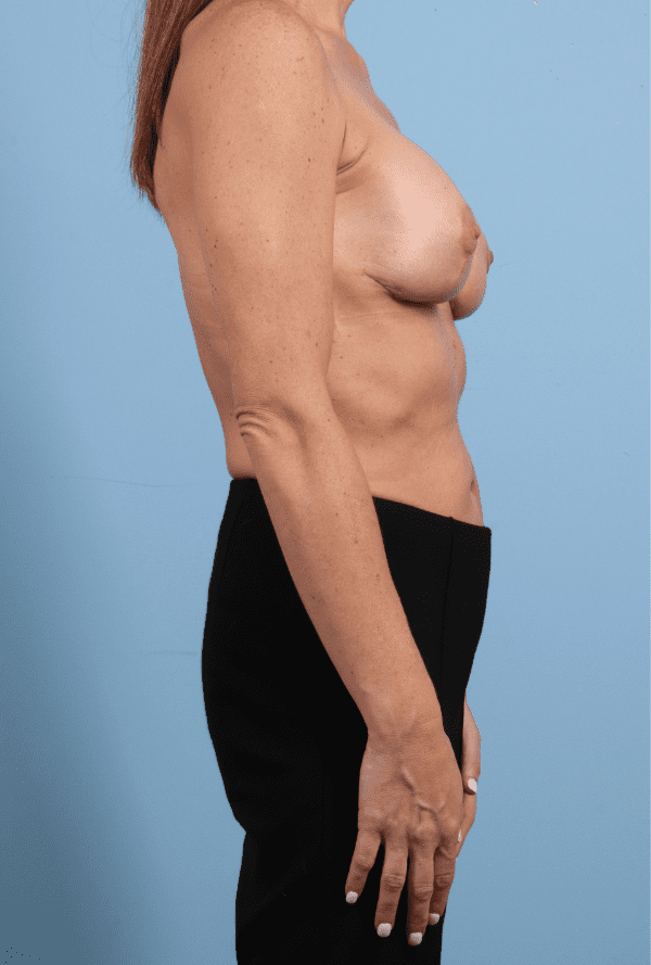 Breast Augmentation Patient Photo - Case 13218 - after view-2