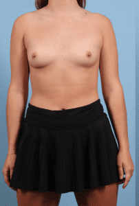 Breast Augmentation - Case 13230 - Before