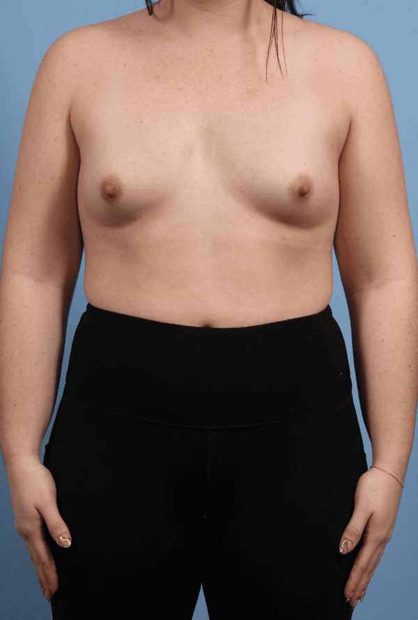 Breast Augmentation Patient Photo - Case 13242 - before view-