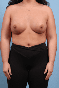 Breast Augmentation - Case 13242 - After