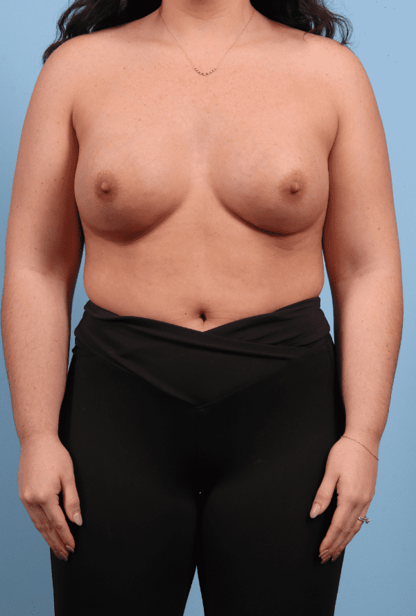 Breast Augmentation Patient Photo - Case 13242 - after view