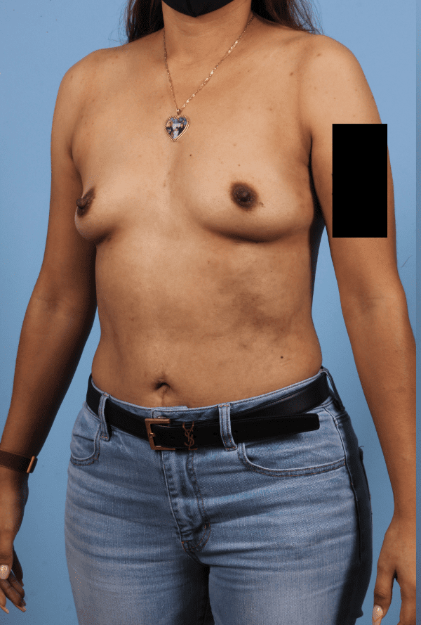 Breast Augmentation Patient Photo - Case 13254 - before view-2