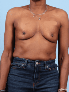 Breast Augmentation - Case 13295 - Before