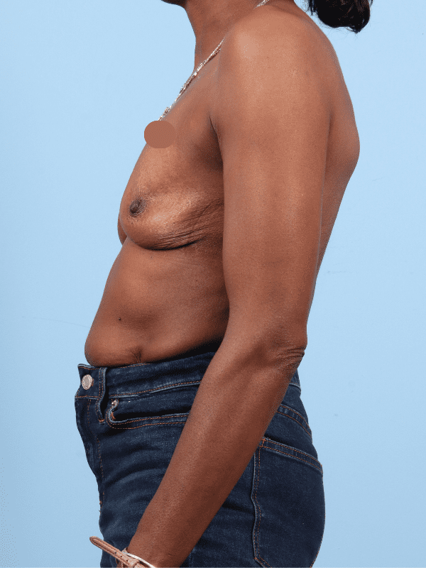 Breast Augmentation Patient Photo - Case 13295 - before view-1