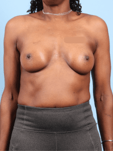 Breast Augmentation - Case 13295 - After