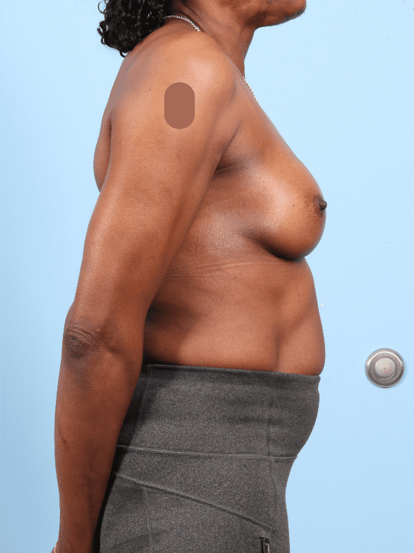 Breast Augmentation Patient Photo - Case 13295 - after view-2