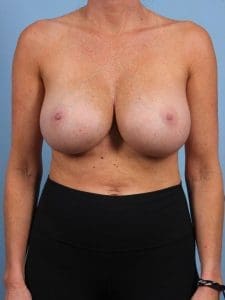 Breast Implant Removal - Case 13333 - Before