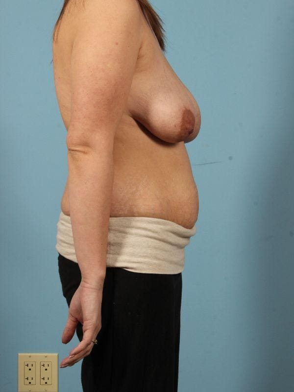 Breast Reduction Patient Photo - Case 13356 - before view-2