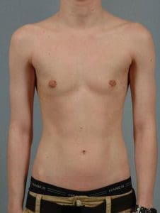 Breast Reduction - Case 13380 - After