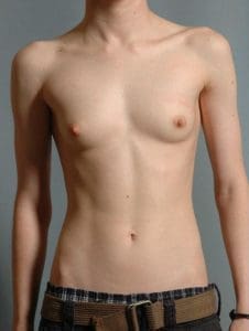 Breast Reduction - Case 13380 - Before