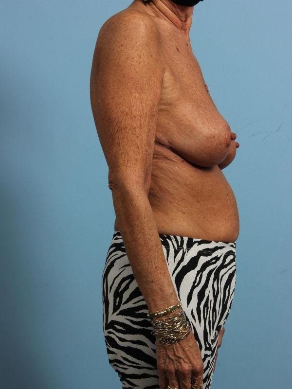Breast Reduction Patient Photo - Case 13425 - after view-2