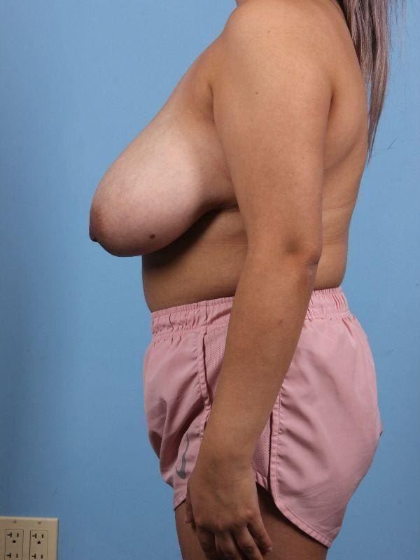 Breast Reduction Patient Photo - Case 13437 - before view-1