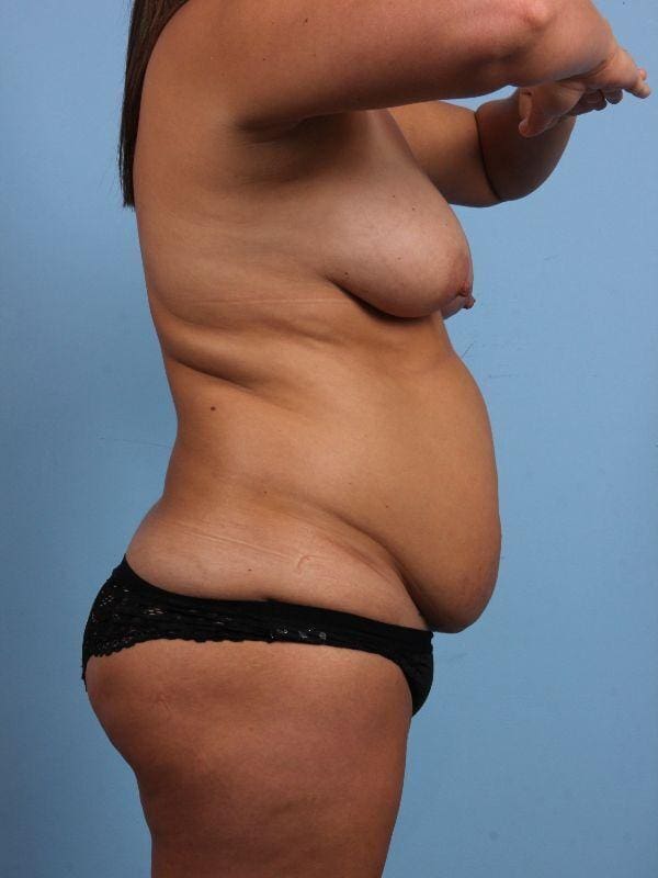 Breast Reduction Patient Photo - Case 13449 - before view-2