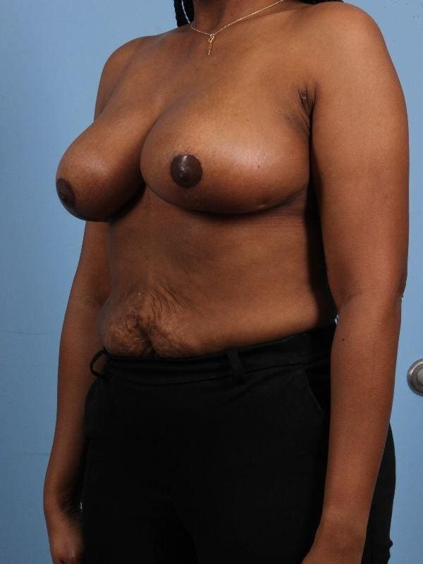 Breast Reduction Patient Photo - Case 13461 - after view-3