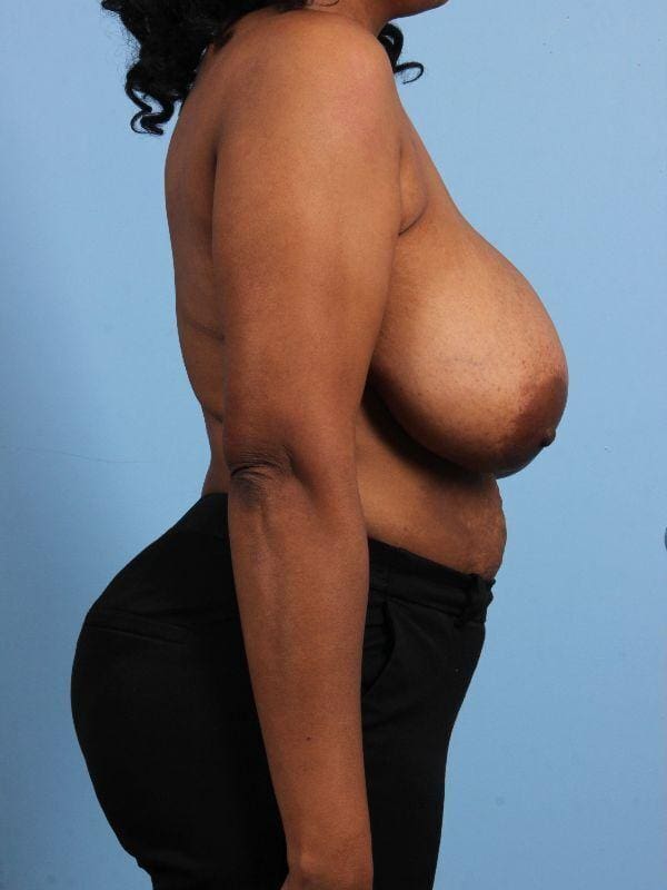 Breast Reduction Patient Photo - Case 13461 - before view-2