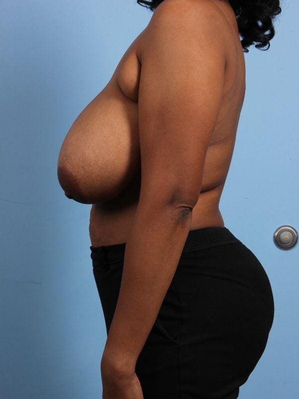 Breast Reduction Patient Photo - Case 13461 - before view-1